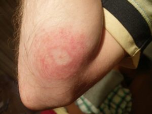 Another view of the ringworm infection on my arm